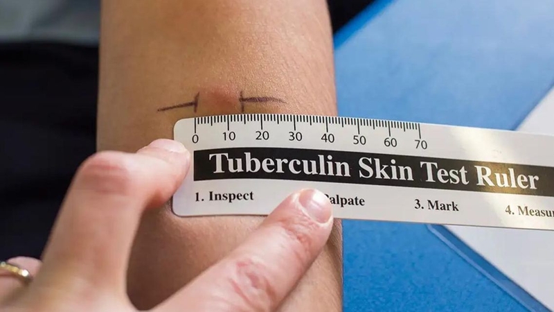 Xét nghiệm lao phổi bao nhiêu tiền là thông tin nhiều bệnh nhân muốn biết